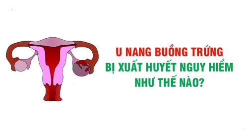 U nang buồng trứng xuất huyết có nguy hiểm không? Xem ngay câu trả lời TẠI ĐÂY!